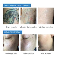 2In1 Diode Laser Hair Removal ND YAG Picosecond Tattoo Removal Skin Care Machine