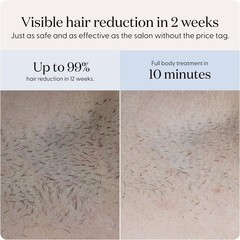 Custom IPL Hair Removal Device for All Skin Types – Trusted Brand 2023