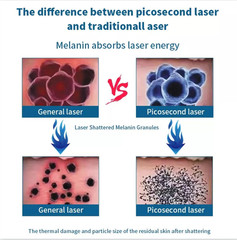 2 In1 Diode Laser Hair Removal & ND Yag Pico Laser Tattoo Removal Skin Care