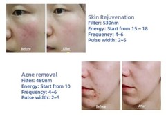 3 IN 1 Nd Yag Laser RF OPT IPL Machine Skin Rejuvenation Hair Tattoo Removal