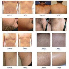 808 Diode Laser Hair Removal Yag 755 808 1064 Diode Laser Hair Removal Machine