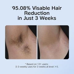 Luxury IPL Hair Removal for Women – Painless, Long-Lasting & Ice Cooling Care