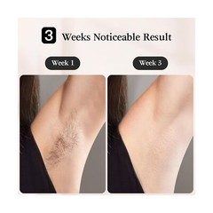 JOVS Laser Hair Removal, [24J Energy] IPL Hair Removal for Women and Men, 37