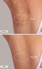 INIA FOND IPL Laser Hair Removal Device At-Home Permanent Hair Reduction NIB
