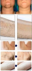 2IN1 755nm 808nm 1064nm Diode Laser Hair Removal Pico Tattoo ND YAG Machine