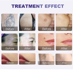 Laser Hair Removal, Picosecond Safe And Painless Hair Removal, Tattoo Removal