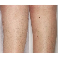 Silk’n BellaFlash Pro Hair Removal System NEW in Box – White