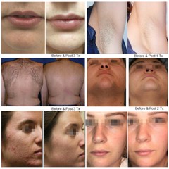 1064nm/755nm/808nm Diode Laser Body Hair Removal Permanent Machine Body & Facial