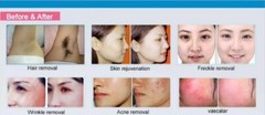 ipl laser hair removal machine shr ipl skin rejuvenation vascular removal Spa