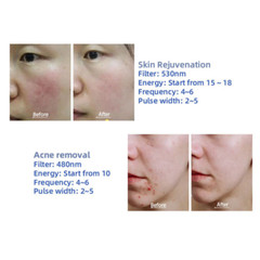 IPL OPT RF Nd Yag Picosecond Laser Hair Removal Tattoo Pigment Removal Machine