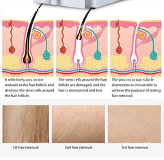 2026 Permanent Depilation Diode Laser Hair Removal Machine 808nm 4 wave