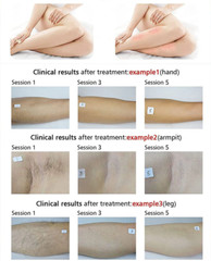 810/755/1064NM Diode Laser Hair Removal Machine Painless Body Skin Rejuvenation