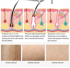 2026 Diode Laser Hair Removal Yag 755 808 1064 Diode Laser Hair Removal Machine