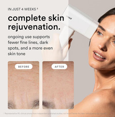 Nood™ NEW Flasher Pro — IPL Laser Hair Removal Device & Anti-Aging Red Light The