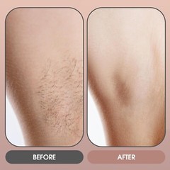 Hair Removal with Ice-Cooling System, Hair Removal for Women and Men, Painless P