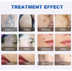 Professional 2 IN 1 Pico Laser Tattoo Hair Removal Skin Rejuvenation Device