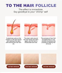 755 808 1064 Diode Laser Permanent Hair Removal Picosecond Nd Yag Tattoo Removal