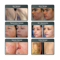 Nd Yag Laser 3 IN1 OPT IPL RF Hair Removal Machine Depilatory Skin Rejuvenation