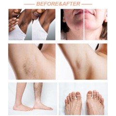 Diode Laser Hair Removal Machine 755 808 1064nm Cooling Head Painless Epilator