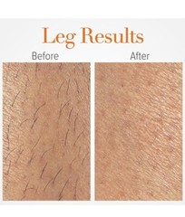 LumaRx Full Body IPL Skin Beauty System (Hair Removal Treatment)