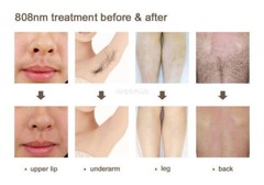 808nm Diode Laser Hair Removal Machine Painless Remove Hair Skin Whitening