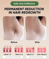 NIB XSOUL At-Home IPL Hair Removal Women Men Permanent 999,999 Flashes Sealed