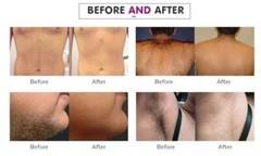 808 Diode Laser Hair Removal Yag 755 808 1064 Diode Laser Hair Removal Machine