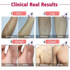 [OPEN BOX] Permanent Hair Removal 4 Women & Men, IMENE T4 T3 500,000 Flashes IPL