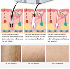 2026 Permanent Depilation Diode Laser Hair Removal Machine 755 808 1064nm