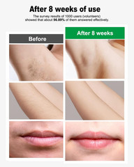 IPL Hair Removal Device, Model: AI06, for Facial Legs Arms Bikini Line