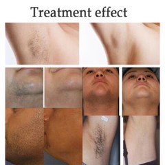 Painless Diode Laser Hair Removal 1064 755 810nm Machine Skin Rejuvenation