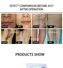 2026 Permanent Depilation Diode Laser Hair Removal Machine 755 808 1064nm