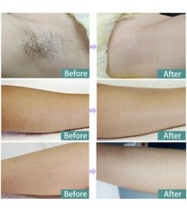 DEESS Permanent Hair Removal Device,350,000 Flashes IPL Hair Removal System