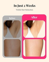 LYSMOSKI Laser Hair Removal for Women and Men, At-Home IPL Hair Removal Device