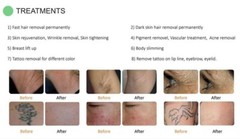 4 in 1 SPA machine Laser hair removal IPL OPT tattoo removal ND-yag laser RF dev