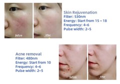 IPL Elight OPT Picosecond Laser RF Laser Hair Rremoval Tattoo Removal Machine