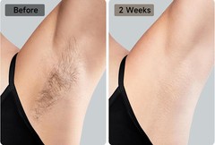 JOVS Laser Hair Removal 37°F with Sapphire Ice-Cooling 3 in 1 Hair Removal