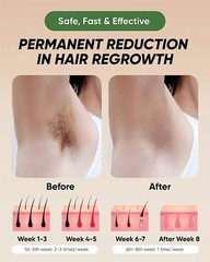 XSOUL At-Home IPL Hair Removal for Women and Men Permanent Hair Removal 999,999