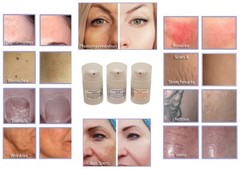 Treatment Gel 3 Pack for Tattoo Pigment & Freckle Removal for IPL & YAG Lasers.