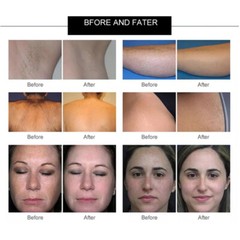DPL Laser IPL RF Permanent Hair Removal Machine Face Body Skin Painless Epilator