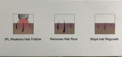 Hena IPL Hair Removal System (600,000 Flashes) OPEN BOX – UNUSED