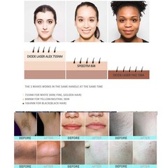 Professtional OPT SHR IPL Hair Removal ND YAG Laser Tattoo Remove Spa Machine