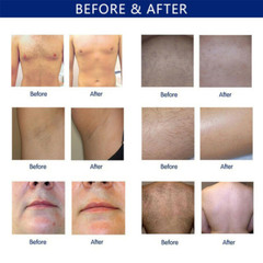 Permanent Diode Laser Hair Removal Machine 1064 755 810nm Skin Rejuvenation