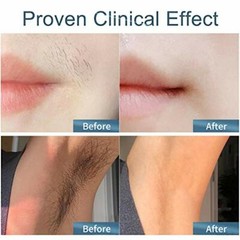 IPL Hair Removal Device Veme 500000 Flashes ICE Surwit-cy01, Surwit-cy01
