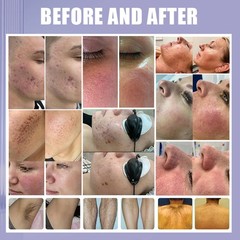 Professtional OPT SHR IPL Hair Removal ND YAG Laser Tattoo Remove Spa Machine