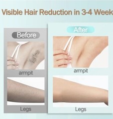 IPL Hair Removal Device, Portable Permanent Hair Reduction for Men and Women,…