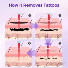 2 in 1 808nm Diode Laser Hair Removal &Pico Nd Yag Laser Tattoo Removal Machine