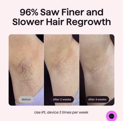 Wavytalk IPL Hair Removal Device, Bare It for Face Body Bikini – Long-Lasting