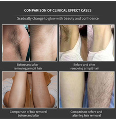 Professional 2026 ICE Titanium 755/808/1064 Diode Laser Hair Removal System