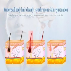 808 Diode Laser Hair Removal Machine 755 808 940 1064nm 10Bars Smooth Skin